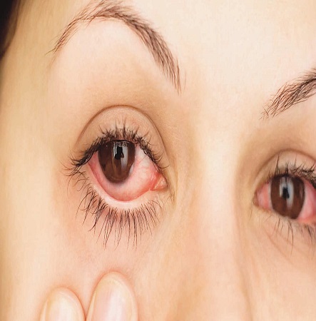 oculistas alergias ojos coruña